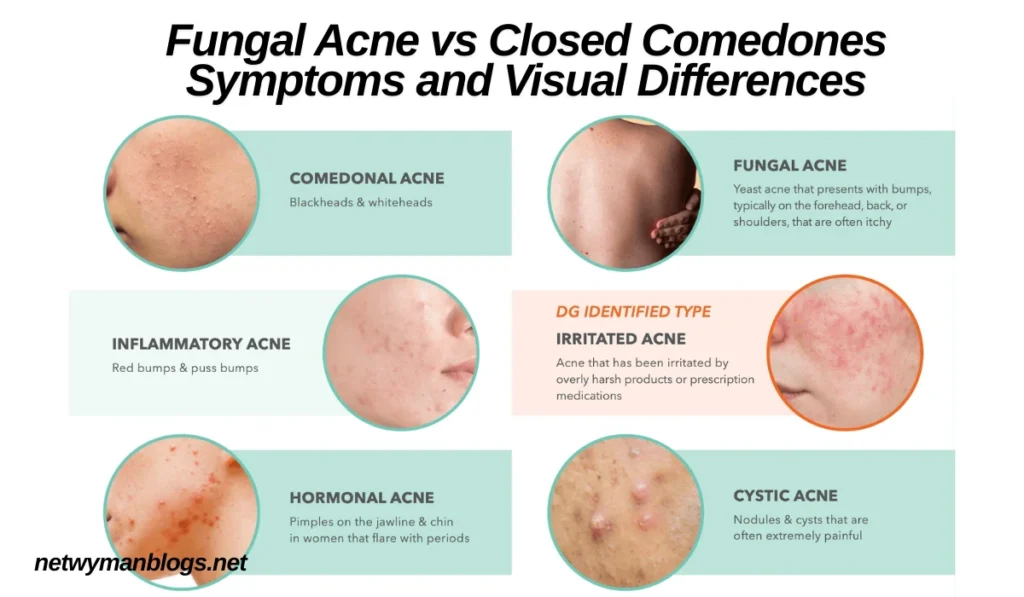 Fungal Acne vs Closed Comedones