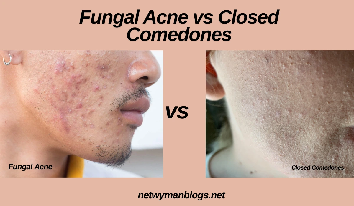 Fungal Acne vs Closed Comedones